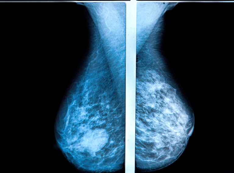 what-does-breast-density-mean