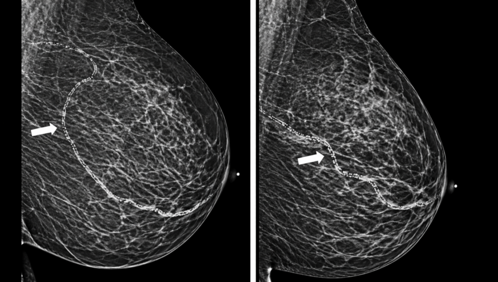 breast arterial calcification