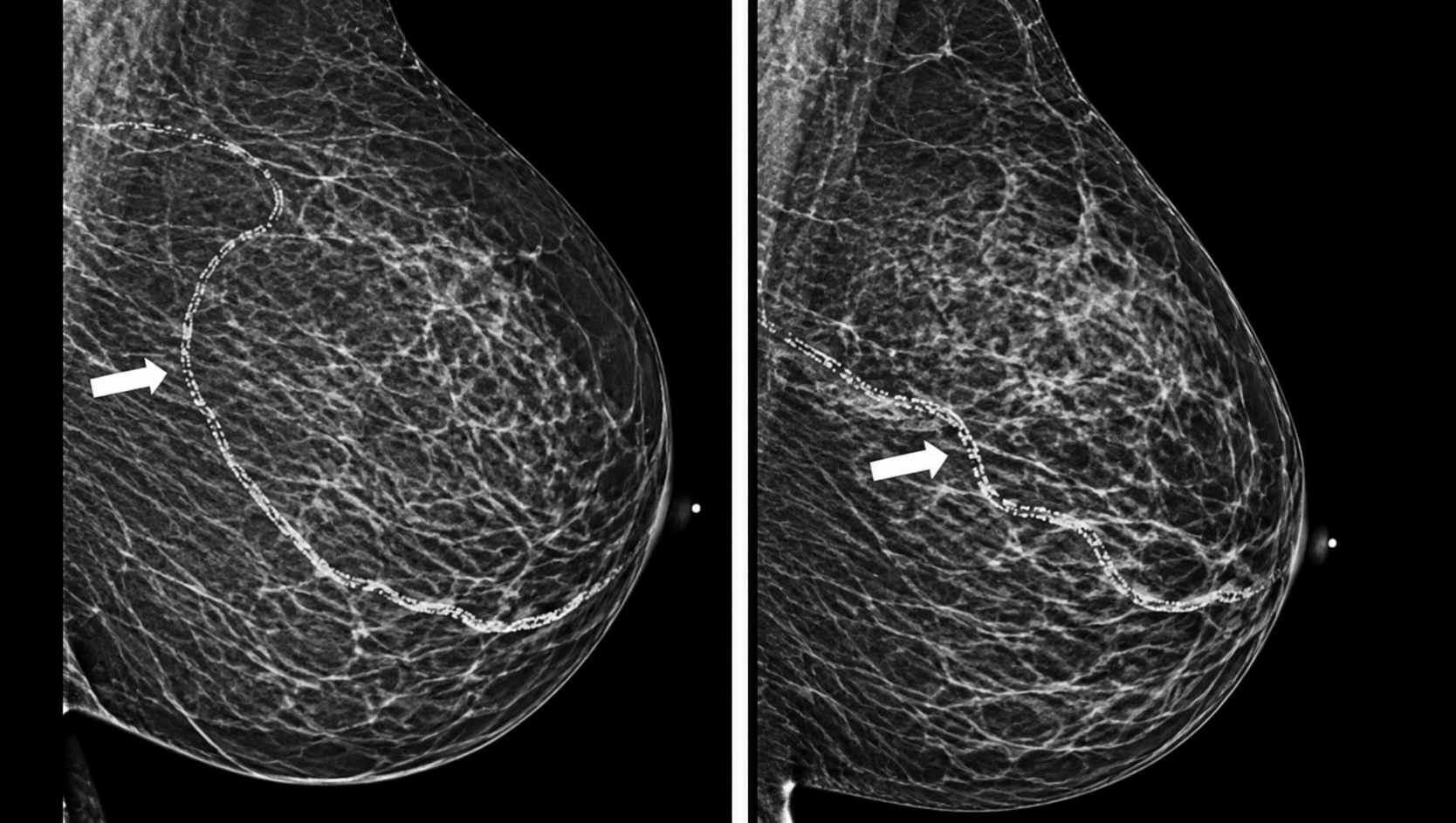 breast arterial calcification