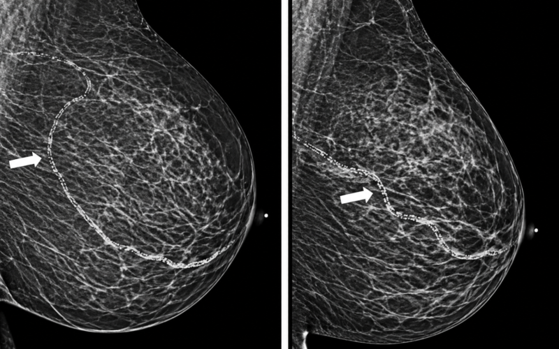 breast arterial calcification
